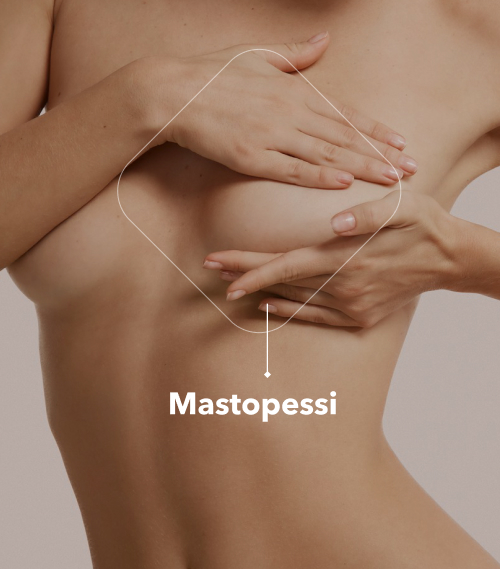 Mastopessi