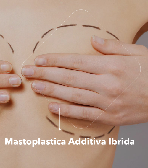 Mastoplastica Additiva Ibrida